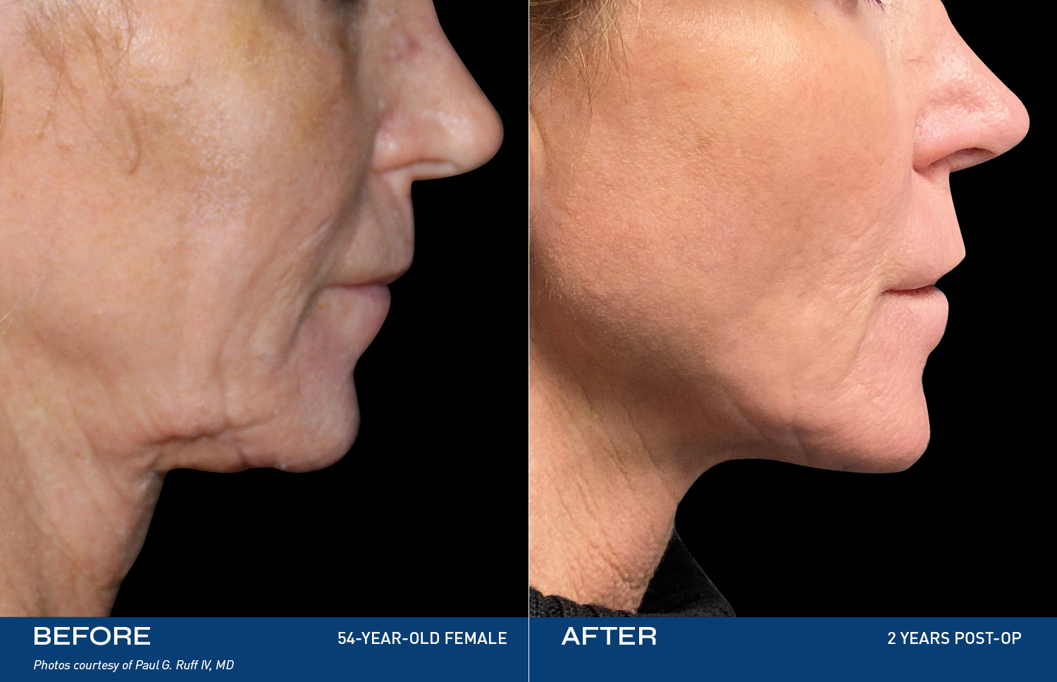 Miracle Skin Tightening® by Renuvion - Chicago Liposuction by Lift